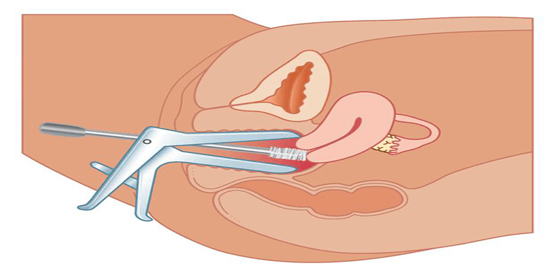 pap-smear-testi